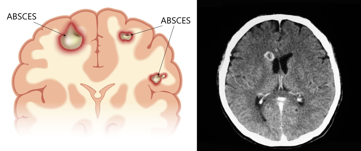 Viste anatomiche e scansioni TC di un ascesso cerebrale