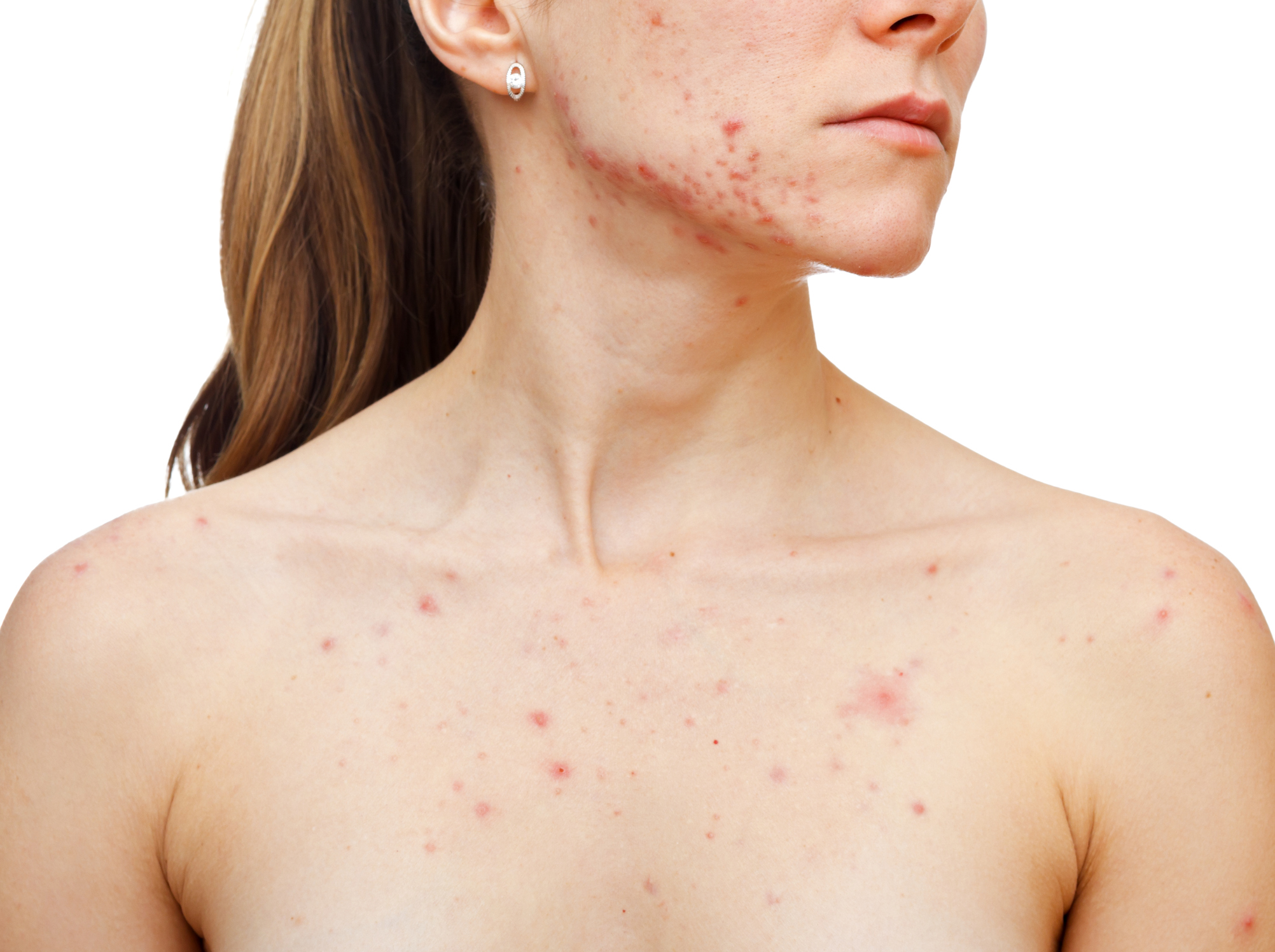 Acne sul viso e sul petto di una donna