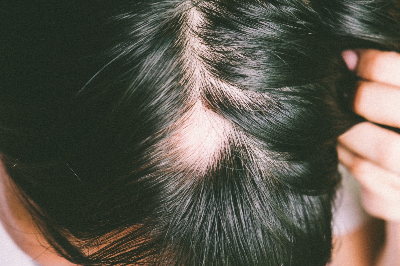 Alopecia, testa, capelli neri, condizione di eccessiva perdita di capelli