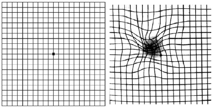 Test di Amsler - griglia nella visione normale e a destra nella degenerazione maculare