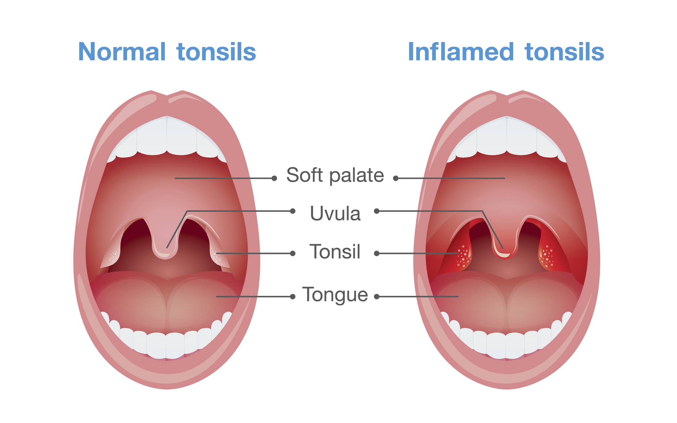 Angina - infiammazione delle tonsille