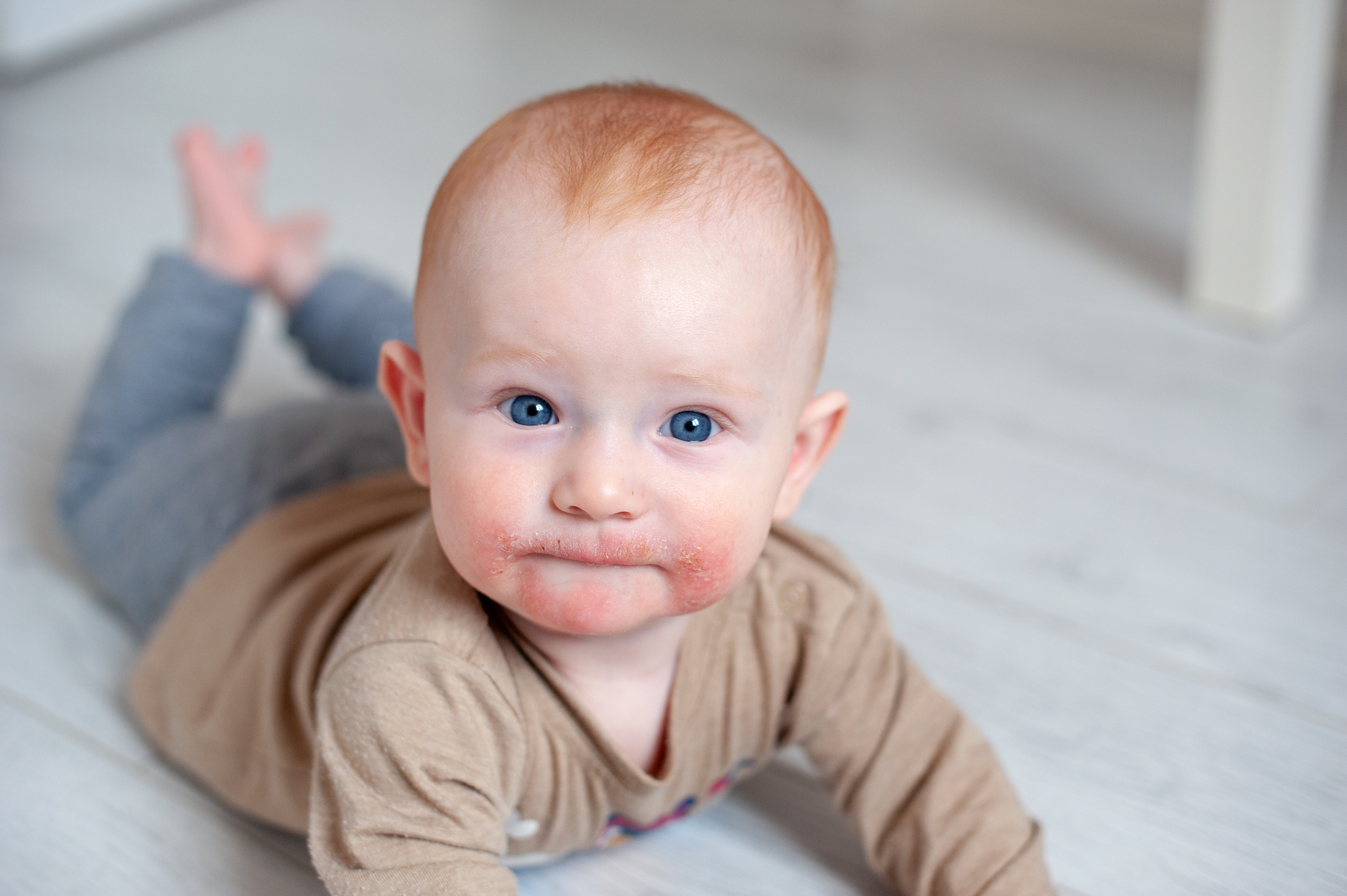 Dermatite atopica sul viso del bambino