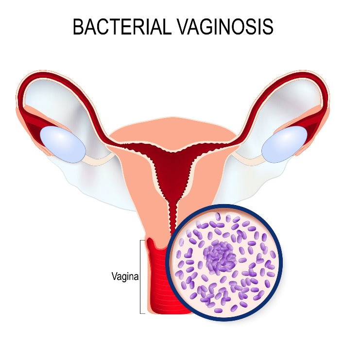 Vaginosi batterica e sovracrescita di Gardnerella vaginalis