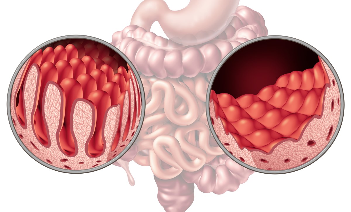 L'intestino e i villi, dove vengono assorbiti i nutrienti, a confronto: sani e danneggiati dalla celiachia