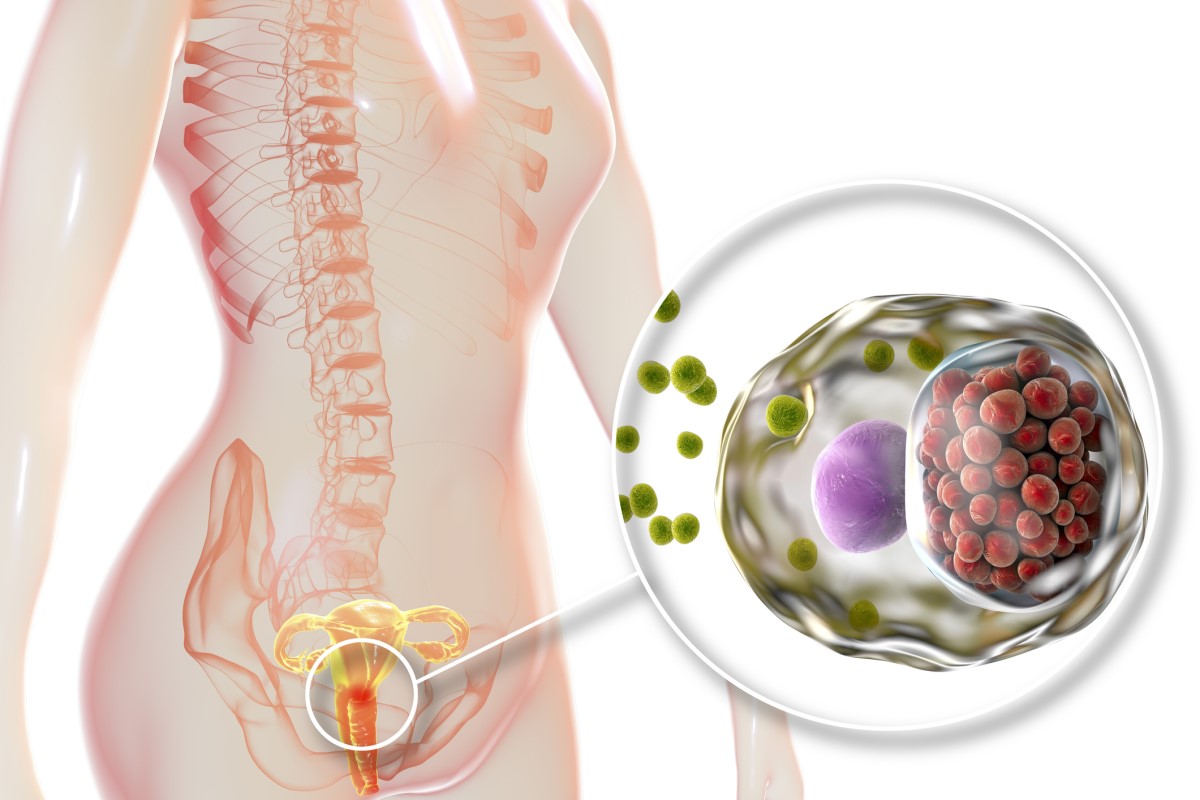 L'infezione ha invaso la cervice - rappresentazione anatomica del sistema riproduttivo femminile