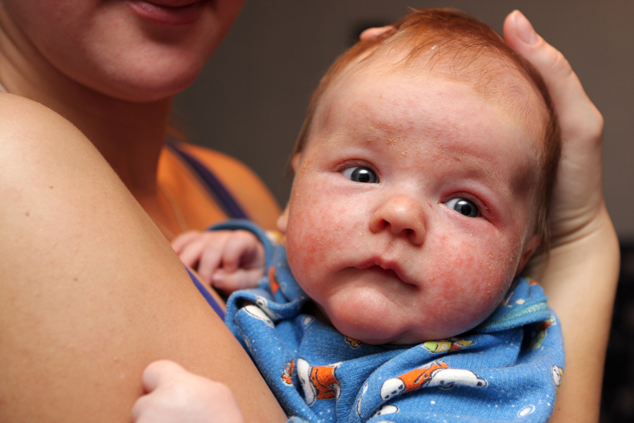 Dermatite sul viso di un bambino piccolo