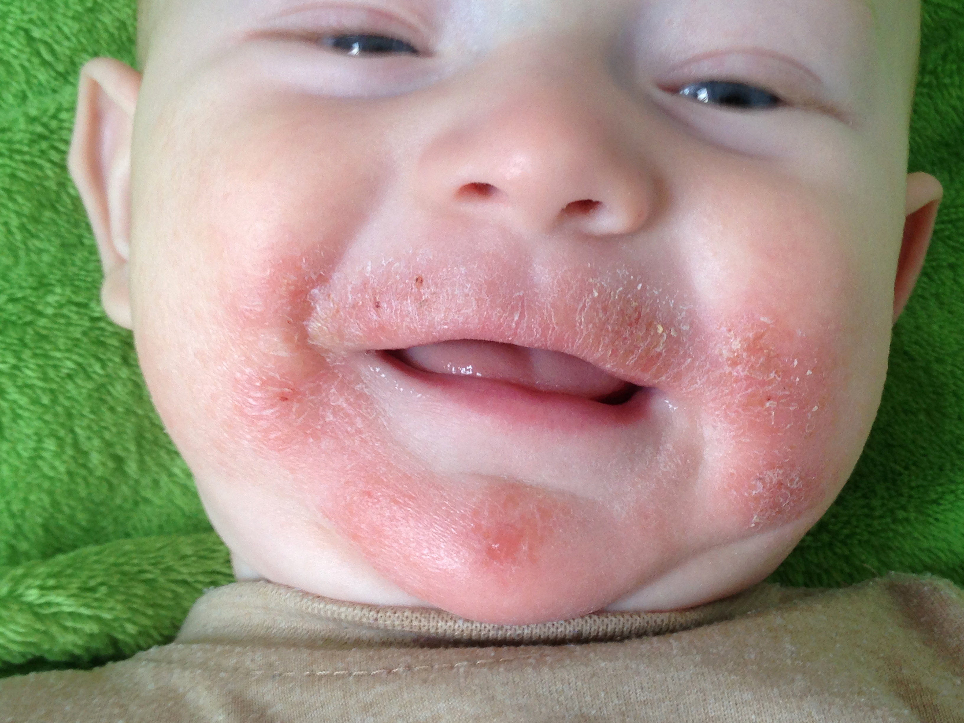 Bambino con eczema atopico