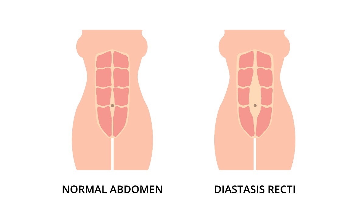 Stato fisiologico della muscolatura addominale e diastasi (distanza) dei muscoli retto addominale sinistro e destro dalla linea mediana della linea alba