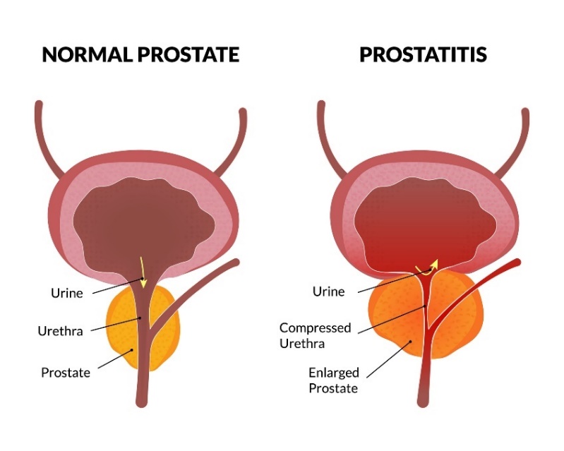 Lo stato fisiologico della prostata e la prostatite