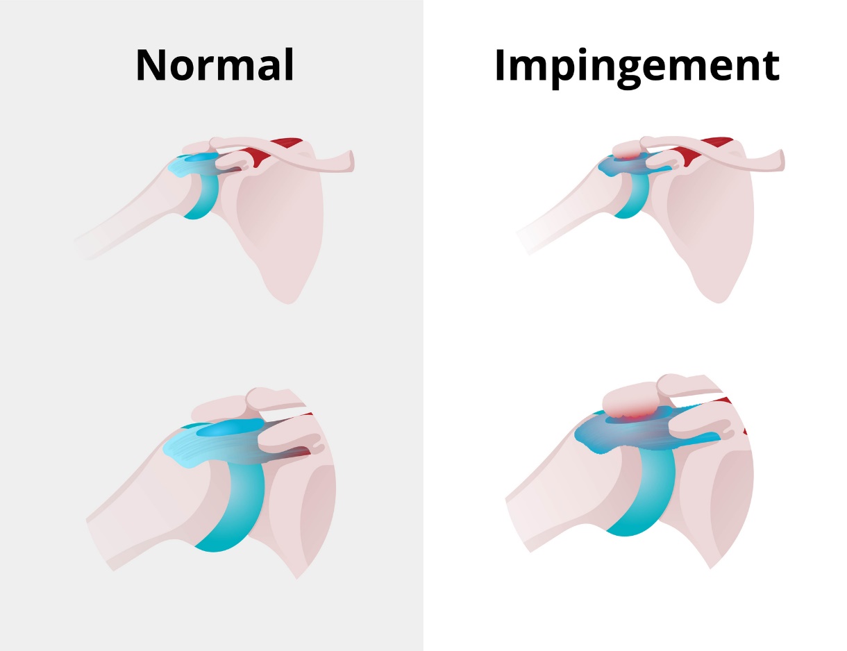 Stato fisiologico dell'articolazione della spalla e sindrome da impingement