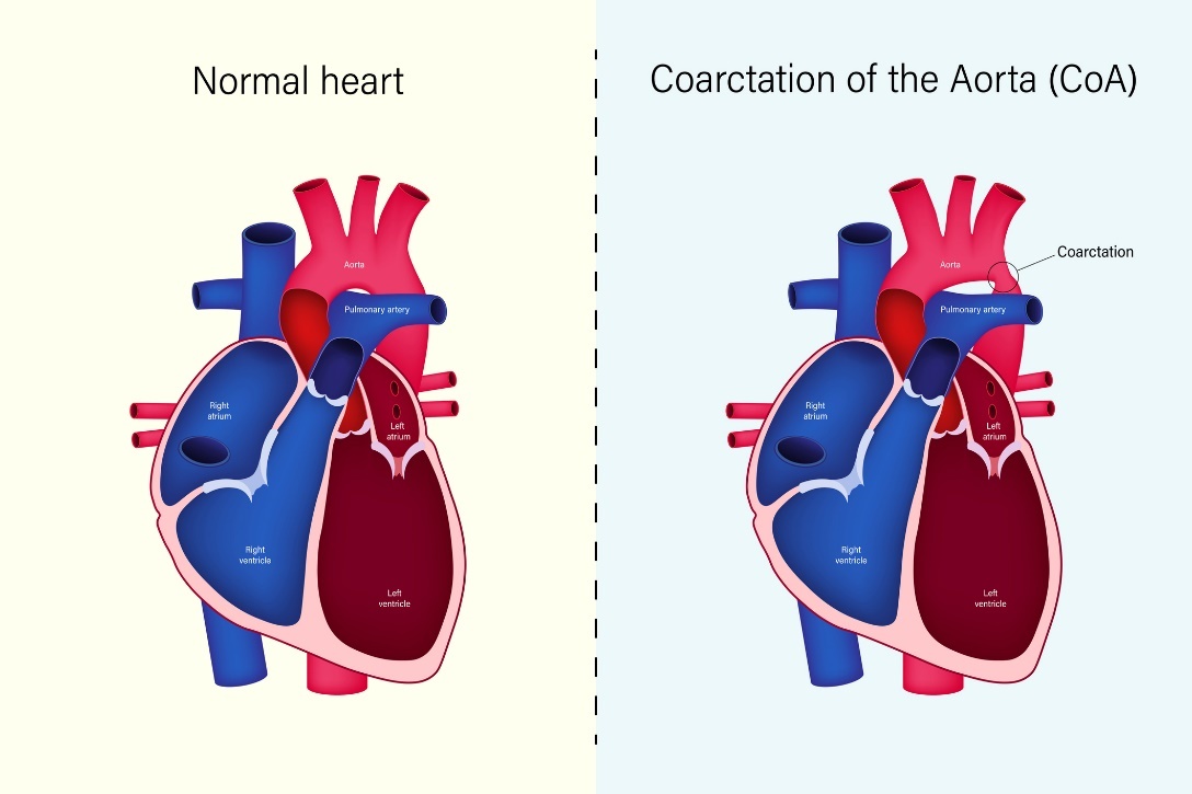 Stato fisiologico del cuore e coartazione dell'aorta (CoA)