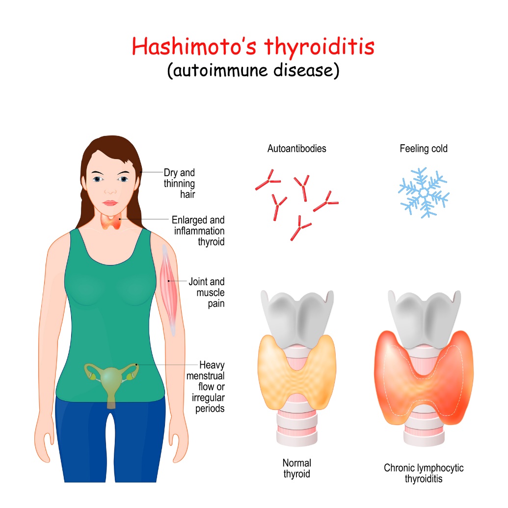 Tiroidite di Hashimoto e sintomi clinici