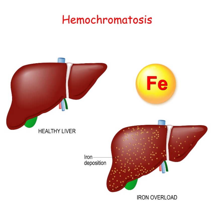 Emocromatosi: fisiologia e patologia del fegato con eccessivo deposito di ferro (Fe)