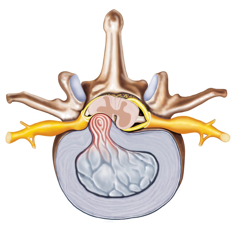 Ernia del disco - rappresentazione anatomica