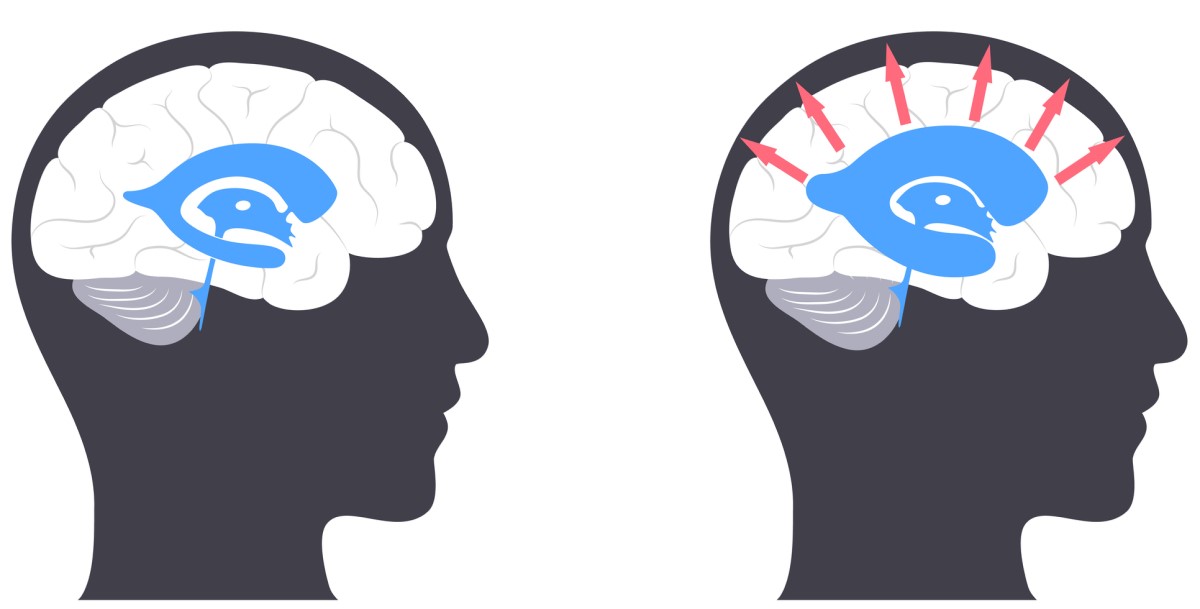 Testa con cervello - a sinistra - cervello normale / a destra - testa con cervello con idrocefalo, dove le frecce dal centro verso l'esterno indicano l'allargamento dei ventricoli cerebrali e la pressione sul tessuto cerebrale.