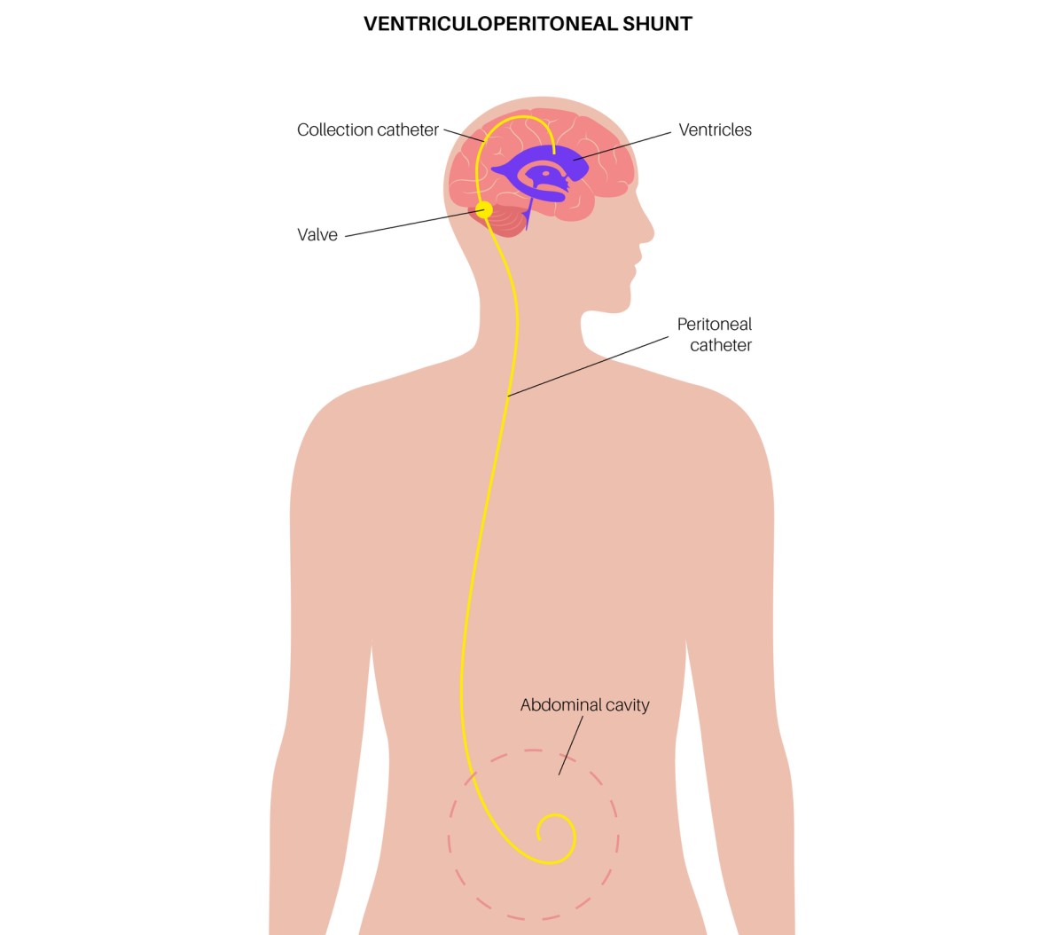 Illustrazione di uno shunt ventricolo-addominale che drena il liquido in eccesso dal cervello alla cavità addominale.