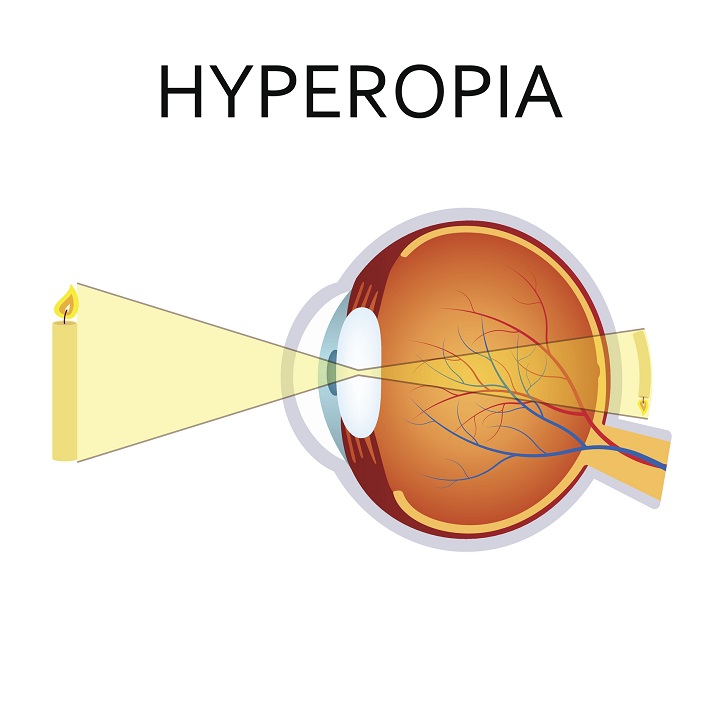 Ipermetropia