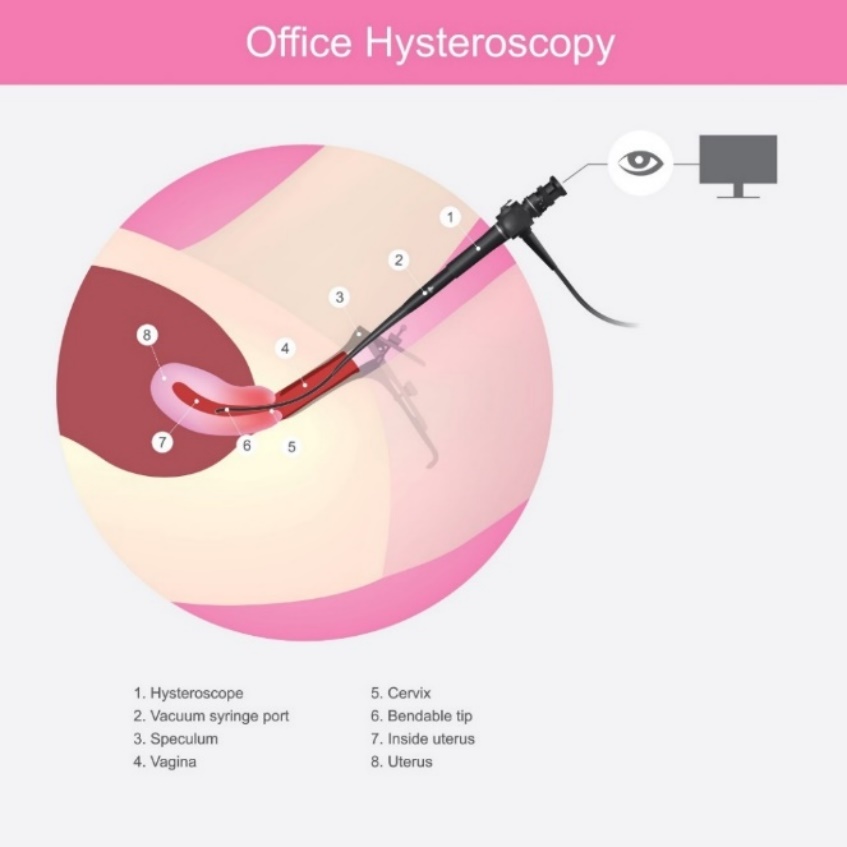 Isteroscopia