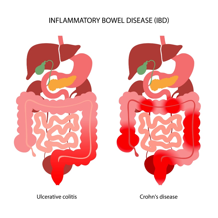 IBD: suddivisione in colite ulcerosa e malattia di Crohn in base alla localizzazione della reazione infiammatoria.