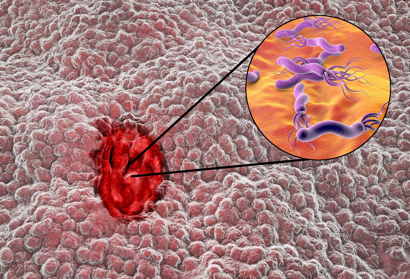 Infezione da Helicobacter pylori