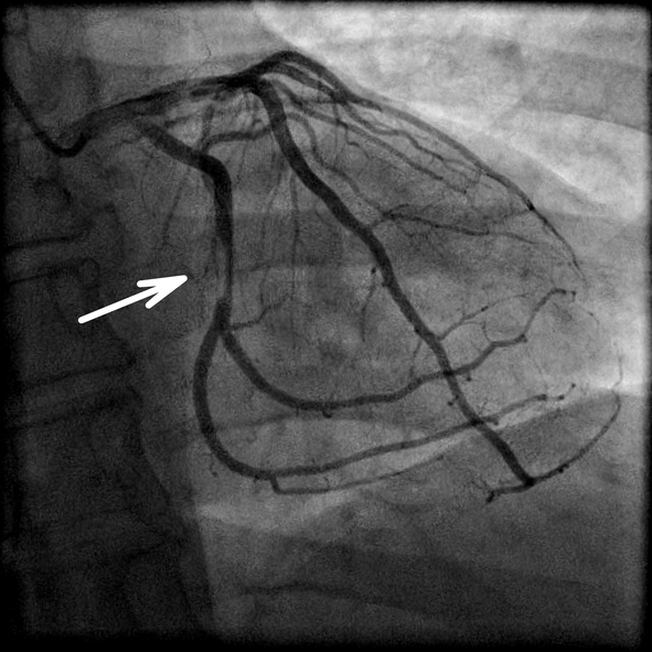 Coronarografia e restringimento dell'arteria cardiaca