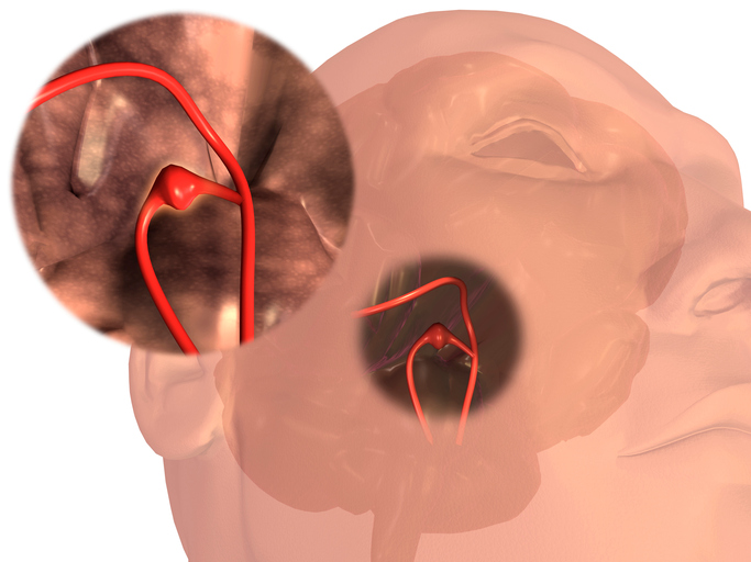 Aneurisma di un vaso sanguigno cerebrale