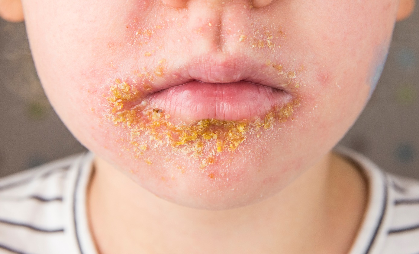 Impetigine nebulosa in un bambino di 5 anni