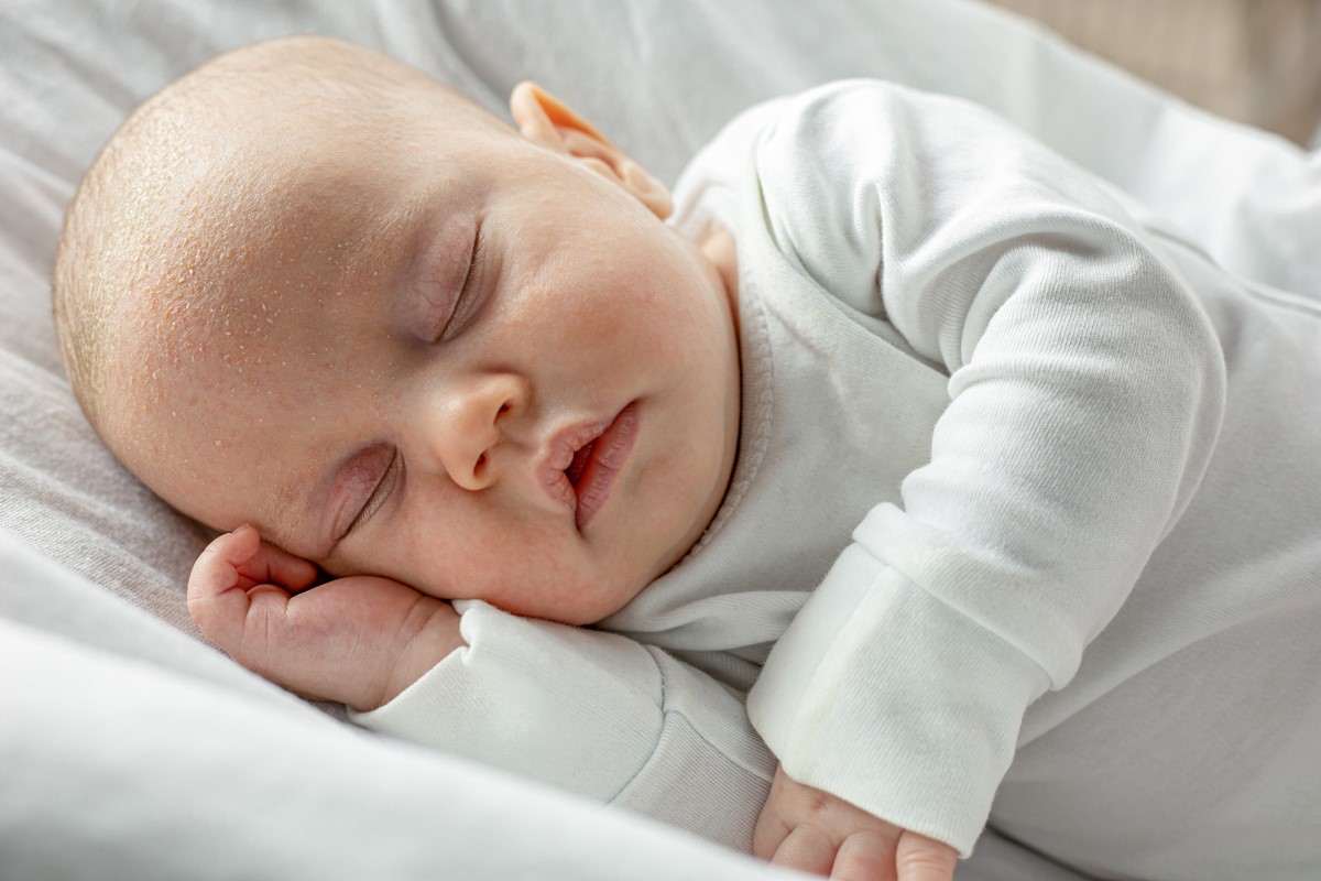 Un bambino piccolo, appena nato, che dorme, con seborrea e squame sulla testa.