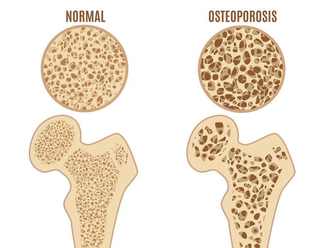 Osteoporosi del femore