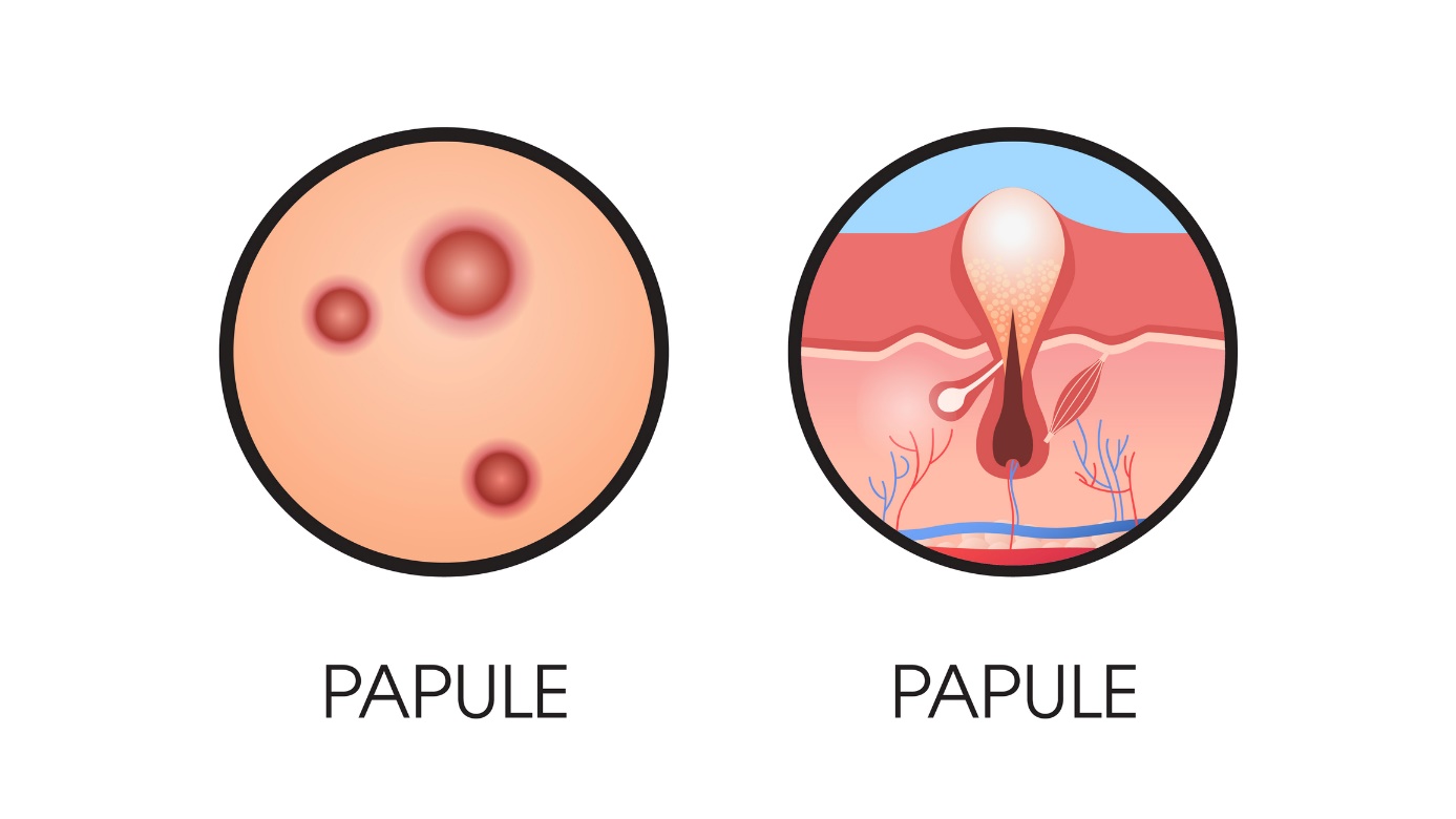 papula sulla pelle