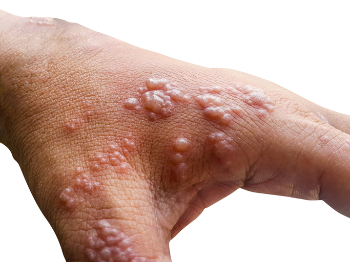 Herpes zoster sulla mano