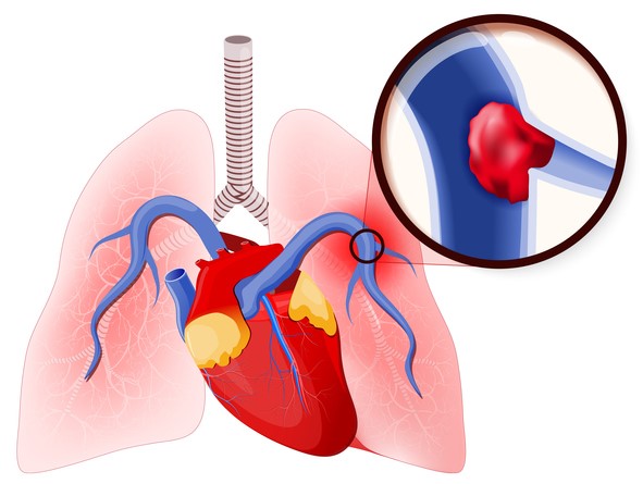 Embolia polmonare, chiusura dell'arteria polmonare da parte di un coagulo di sangue.