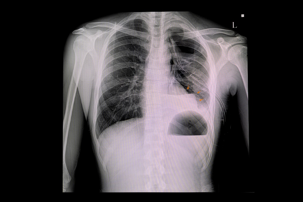 Radiografia di pneumotorace del polmone sinistro e accumulo di aria nella cavità pleurica del torace (colore bianco)