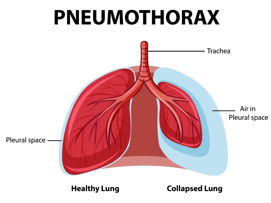 Pneumotorace: polmoni sani e collassati