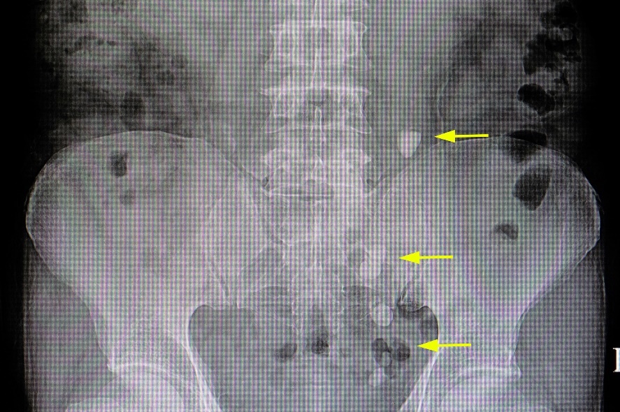 Radiografia: numerosi concrementi nel corso del tratto urinario