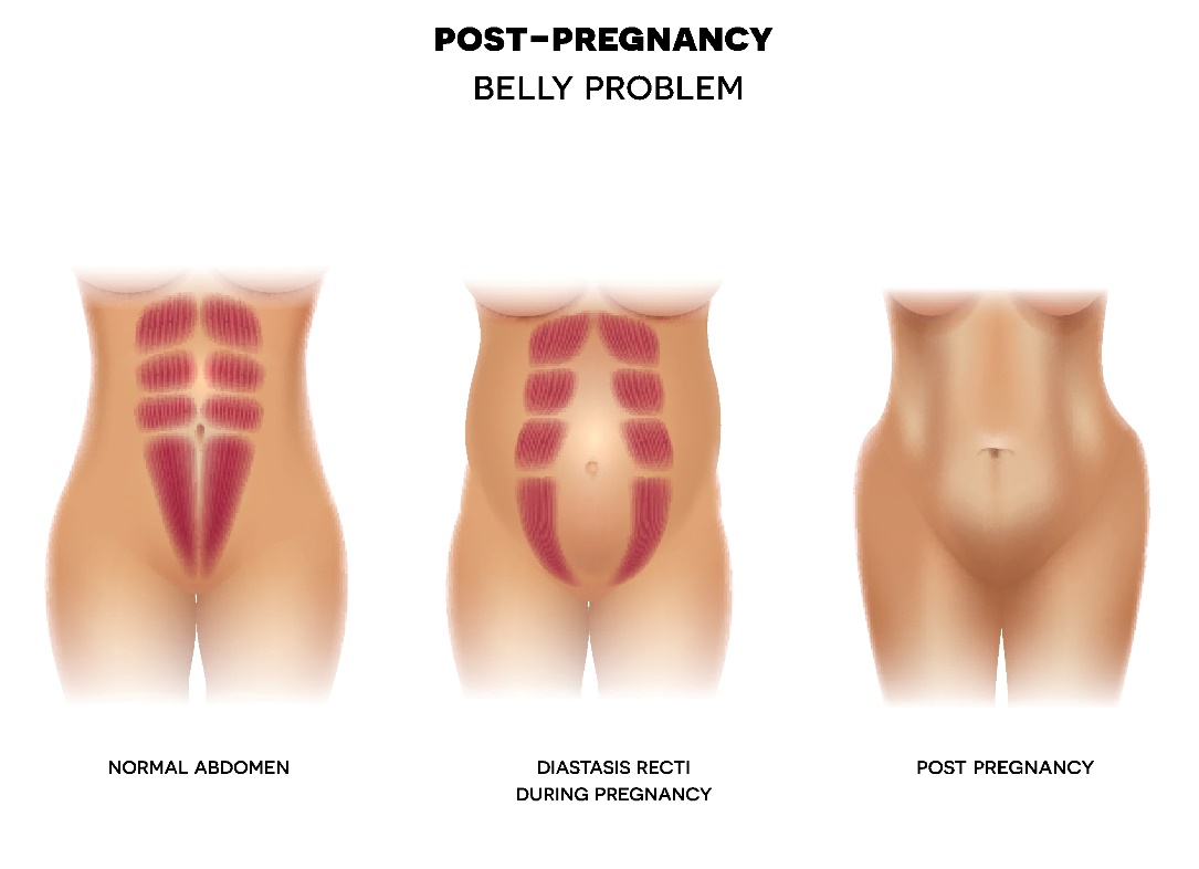 Diastasi post-partum della parete addominale