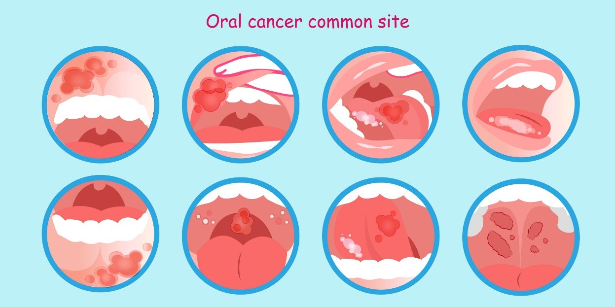 Cancro orale e depositi tumorali: un modello