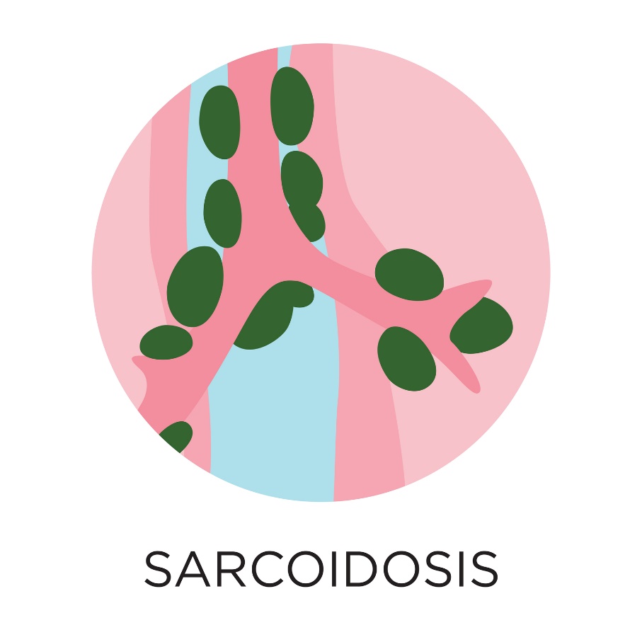 Sarcoidosi - formazione di granulomi