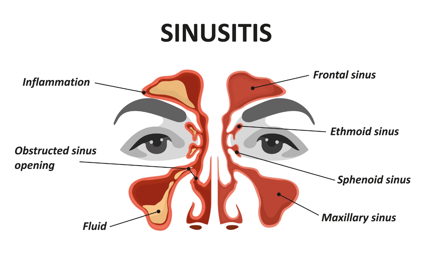 Modello/immagine animata di sinusite e sinusite