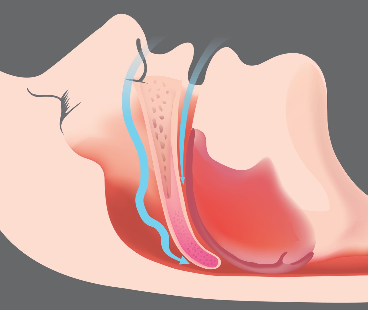 Apnea ostruttiva e ostruzione delle vie aeree - immagine animata e modello delle vie aeree