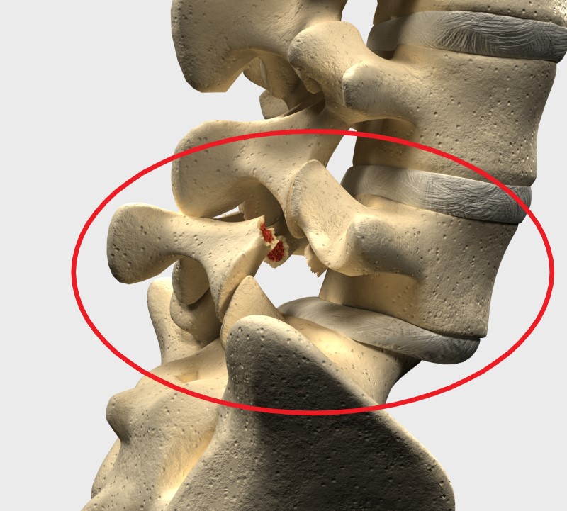 Spondilolistesi nella regione lombare L5 e S1 - Modello di scheletro spinale