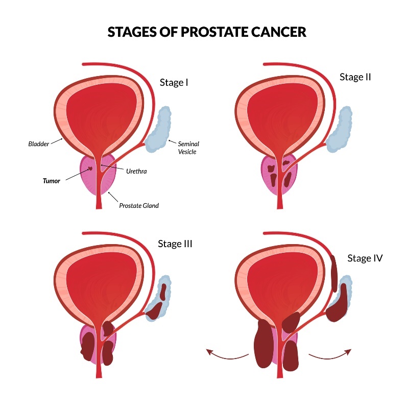 I 4 stadi fondamentali del cancro alla prostata