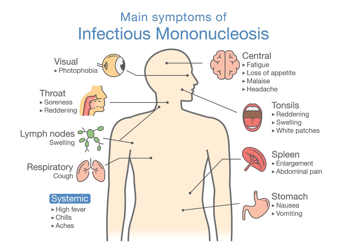 Sintomi della mononucleosi infettiva