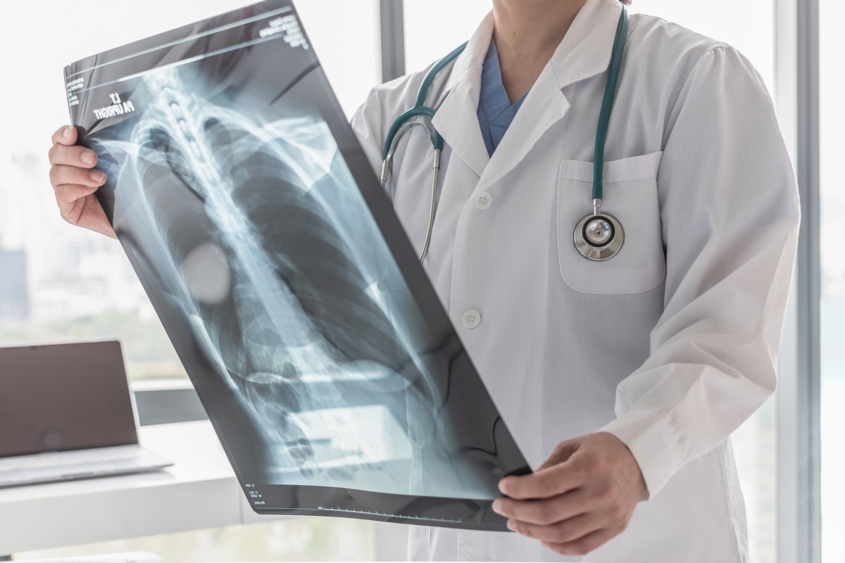 Tubercolosi polmonare: quali sono i sintomi, le cause e la contagiosità