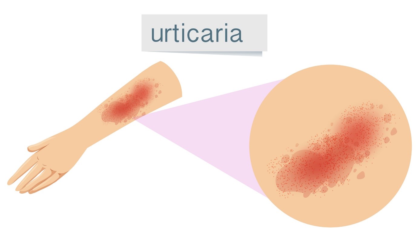 Orticaria, orticaria, orticaria, orticaria, orticaria, orticaria