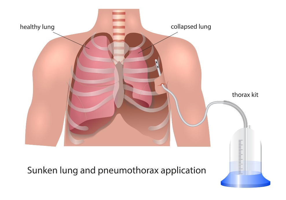 Visualizzazione del drenaggio pleurico nel pneumotorace: polmone sano, polmone collassato e dispositivo di drenaggio