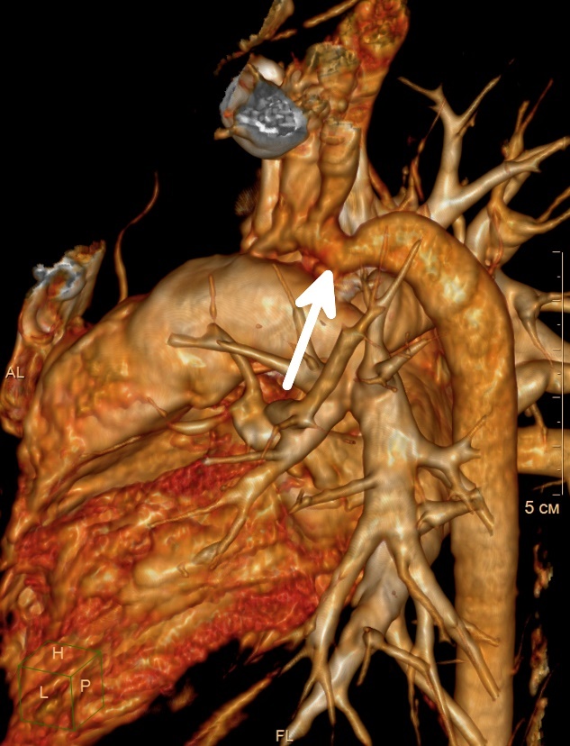 Visualizzazione della coartazione (restringimento) dell'aorta nella parte discendente del vaso cardiaco.