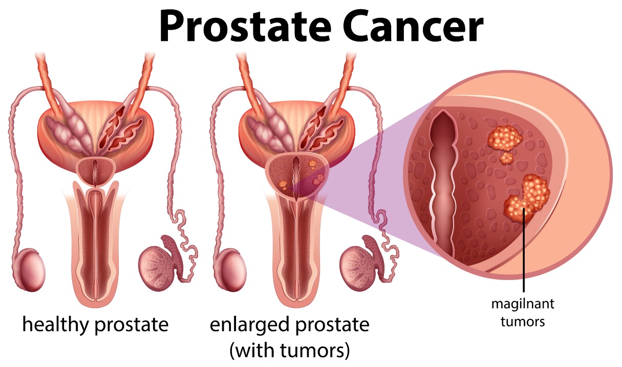 Cancro della prostata: prostata sana e prostata ingrossata con tumore