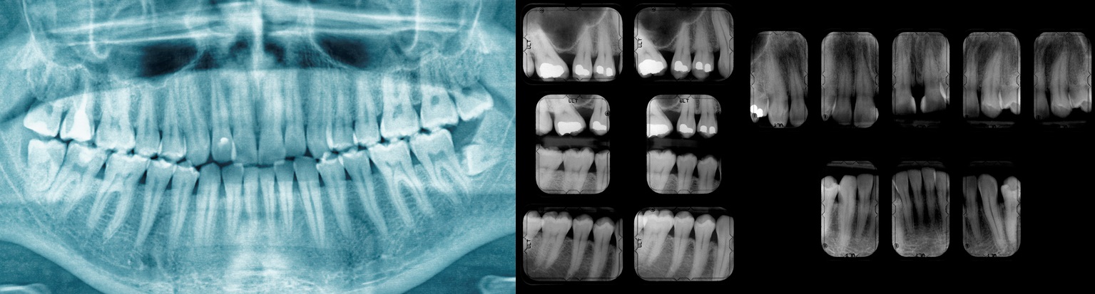 Radiografia dentale per evidenziare lo stato dei denti, la carie e le otturazioni