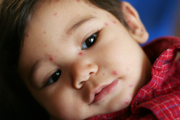 bambino in camicia rossa con la varicella